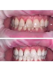 Teeth Whitening - Team Kroh Dental & Facial Aesthetics