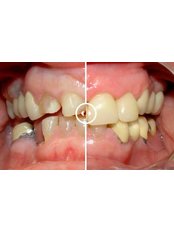 Veneers - Clínica Dental Cots