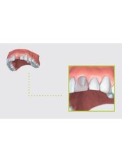 Single Implant - Clínica Dental Cots