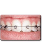 Fixed Braces - Orthodontie MC20
