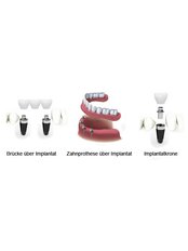 Dental Implants - Zahnexperten Ungarn