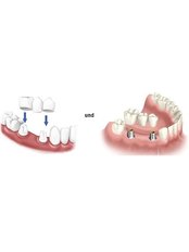 Dental Crowns - Zahnexperten Ungarn