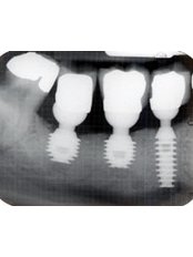 Dental Implants - The specialty dental clinic for oral surgery & dental implant