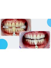 Zoom! Teeth Whitening - AOS Smart Clinic