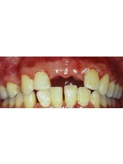 Dental Bridges - BFC Dental