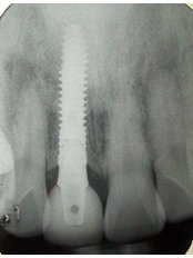Dental Implants - BFC Dental