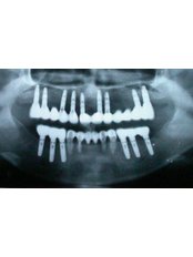 Dental Implants - BFC Dental