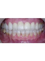 Dental Crowns - BFC Dental
