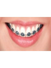 Metal Braces - Thonglor Dental Hospital