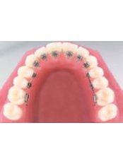 Lingual Braces - Thonglor Dental Hospital