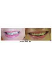 Dental Bridges - Pattaya Smile Dental Clinic - Banglamung