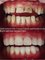Thai Smile Dental Clinic by Dr.Nan @ Jomtien Beach, Pattaya - Teeth repair - smile improvement - by Dr.Nan - Ceramic / Porcelain Crown - Veneer 