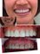 Thai Smile Dental Clinic Pattaya - correct discolored teeth with Ceramic / Porcelain Veneer - Smile Make Over by Dr.Nan 