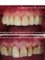 Thai Smile Dental Clinic Pattaya - Smile improvement - Smile Make Over by Dr.Nan - Ceramic / Porcelain Crown - Veneer 