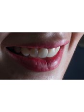 Porcelain Veneers - Dental Design Clinic