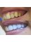 Cabinet dentaire docteur Zied Ben Hamed - 	 Dental veneer 