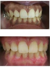 Cabinet dentaire docteur Zied Ben Hamed - Depigmentation  