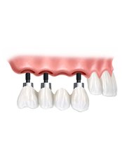 Dental Implants - Cabinet KACEM