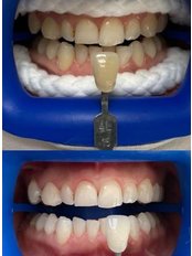 Teeth Whitening - Positive Dental Studio