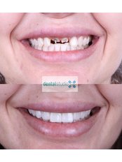 Dental Implants - Positive Dental Studio