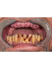 All-on-4 Dental Implants - Akadentia Private Oral And Dental Health Clinic