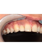 Dental Implants - Akadentia Private Oral And Dental Health Clinic