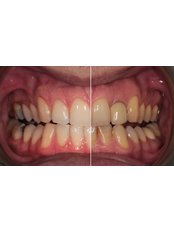Teeth Whitening (Bleaching) - Akadentia Private Oral And Dental Health Clinic
