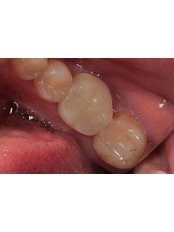 CAD/CAM Dental Restorations - Akadentia Private Oral And Dental Health Clinic
