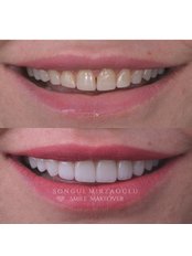 Hollywood Smile - Dent Umitkoy Dental Clinic