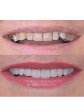 Veneers - Dent Umitkoy Dental Clinic