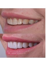 Veneers - Dent Umitkoy Dental Clinic