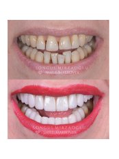 Hollywood Smile - Dent Umitkoy Dental Clinic