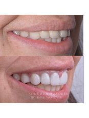 Smile Makeover - Dent Umitkoy Dental Clinic