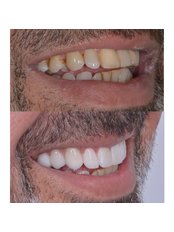 Porcelain Crown - Dent Umitkoy Dental Clinic