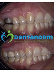 Porcelain Veneers - Dentanorm Oral and Dental Health Clinic