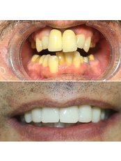 Veneers - Dentanorm Oral and Dental Health Clinic