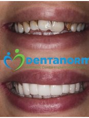 Zirconia Crown - Dentanorm Oral and Dental Health Clinic