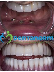 Dental Implants - Dentanorm Oral and Dental Health Clinic