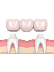 Dental Bridges - Doctor Bayar