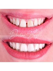 Dental Bonding - Doctor Bayar