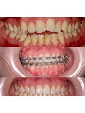 Orthodontics - Redent Oral and Dental Health Polyclinic- Yenikent Branch