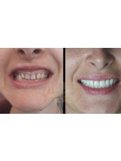 Dental Implants - Alanya Dental Place