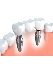 Dental Implants - Cleopatra Dent