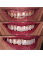 Gum Contouring and Reshaping - Risus Dental Center