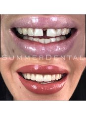 Veneers - Summer Dental