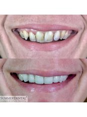 Laminate Veneers - Summer Dental