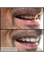 Zirconia Crown - Summer Dental