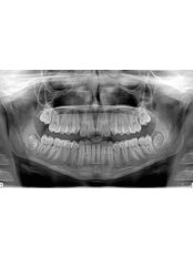Digital Panoramic Dental X-Ray - ACARDENT TURKEY