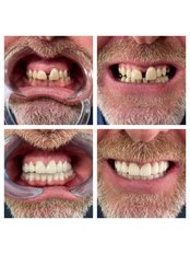 Zirconia Crown - a-dent Dental Clinic