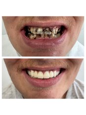 Zirconia Crown - a-dent Dental Clinic